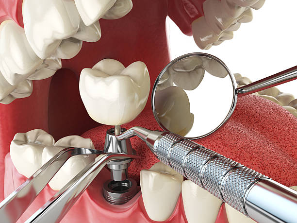 Best Emergency Wisdom Tooth Extraction in Hudson, TX